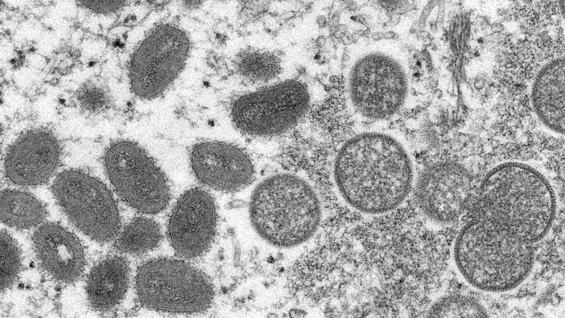 New Jersey health officials probe first probable case of monkeypox